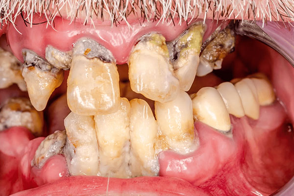 ボロボロの歯