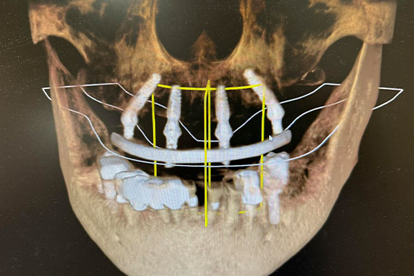 シミュレーション